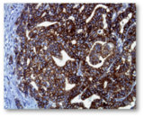 几乎全部肿瘤细胞的乙型HER2多活性