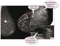 Kuopio大学医院放射科Mazen Sudah博士、赫尔辛基大学医院放射科Katja Hukkinen博士和赫尔辛基大学医院病理学系Paivi Heikkil