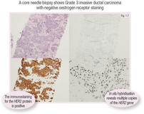 Kuopio大学医院放射科Mazen Sudah博士、赫尔辛基大学医院放射科Katja Hukkinen博士和赫尔辛基大学医院病理学系Paivi Heikkil
